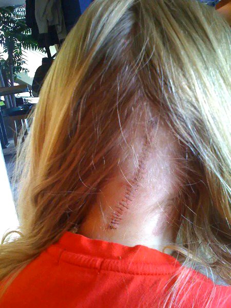 .. stitches ..