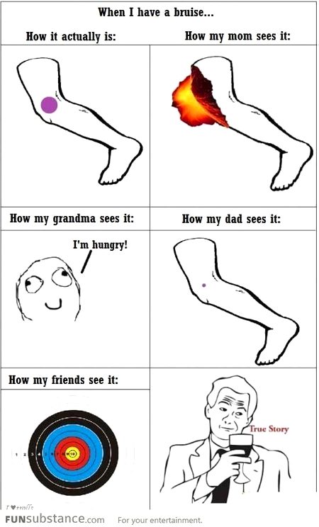 How different people sees my bruise