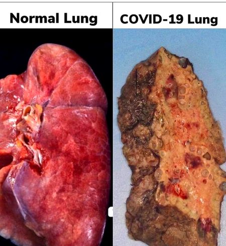 normal vs covid-19 😐