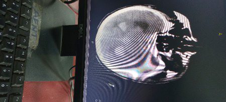 Case of RTA...Intracerebral bleed with traumatic subarachniod hemorrhage ..