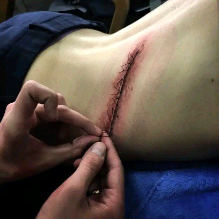 I'll be needing stitches