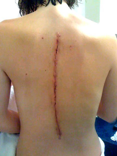 After spine correction