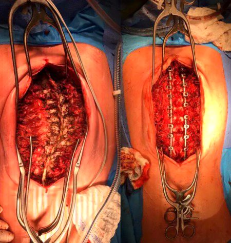 spine correction