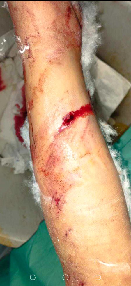 In a random road accident