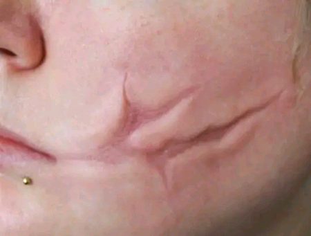 .. scars ..