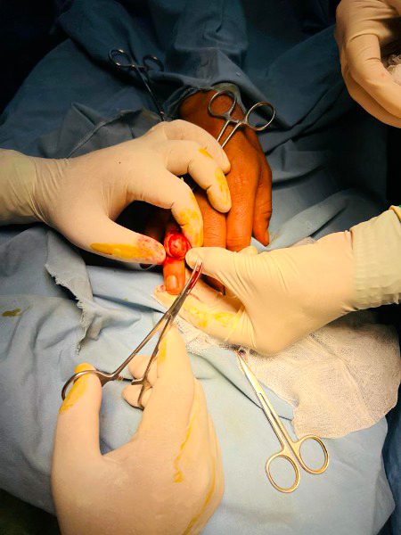 Ganglion cyst excision