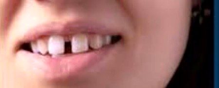 انسانوں میں فاصلہ تو سنا ہوگا آپ لوگوں نے 
لیکن میرے دانتوں میں فاصلہ بڑھ رہا دن با دن عجیب ٹینشن لگی ہوئی ☹️😓🍀🍁🩵