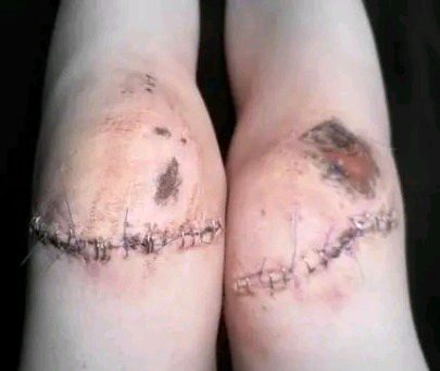 scars and stitches