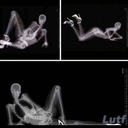 as a x-ray specialist leme show you some tiktoker's results