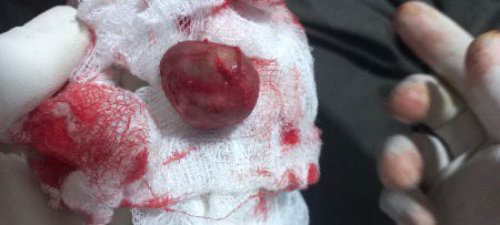 Sebaceous cyst excision done today..