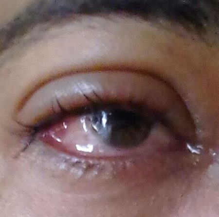 Maleriya fvr ky baad hr ek insan bachy bary sbme ye  ankho ka وائرس  aya hin aska elage atna hin ky br br normal pani lgaya jye 3 4 din bd ankhi sahi ho jyege