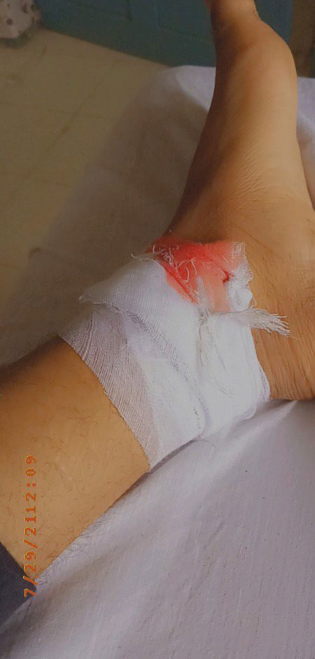 Chooot Aa gyi😔😔